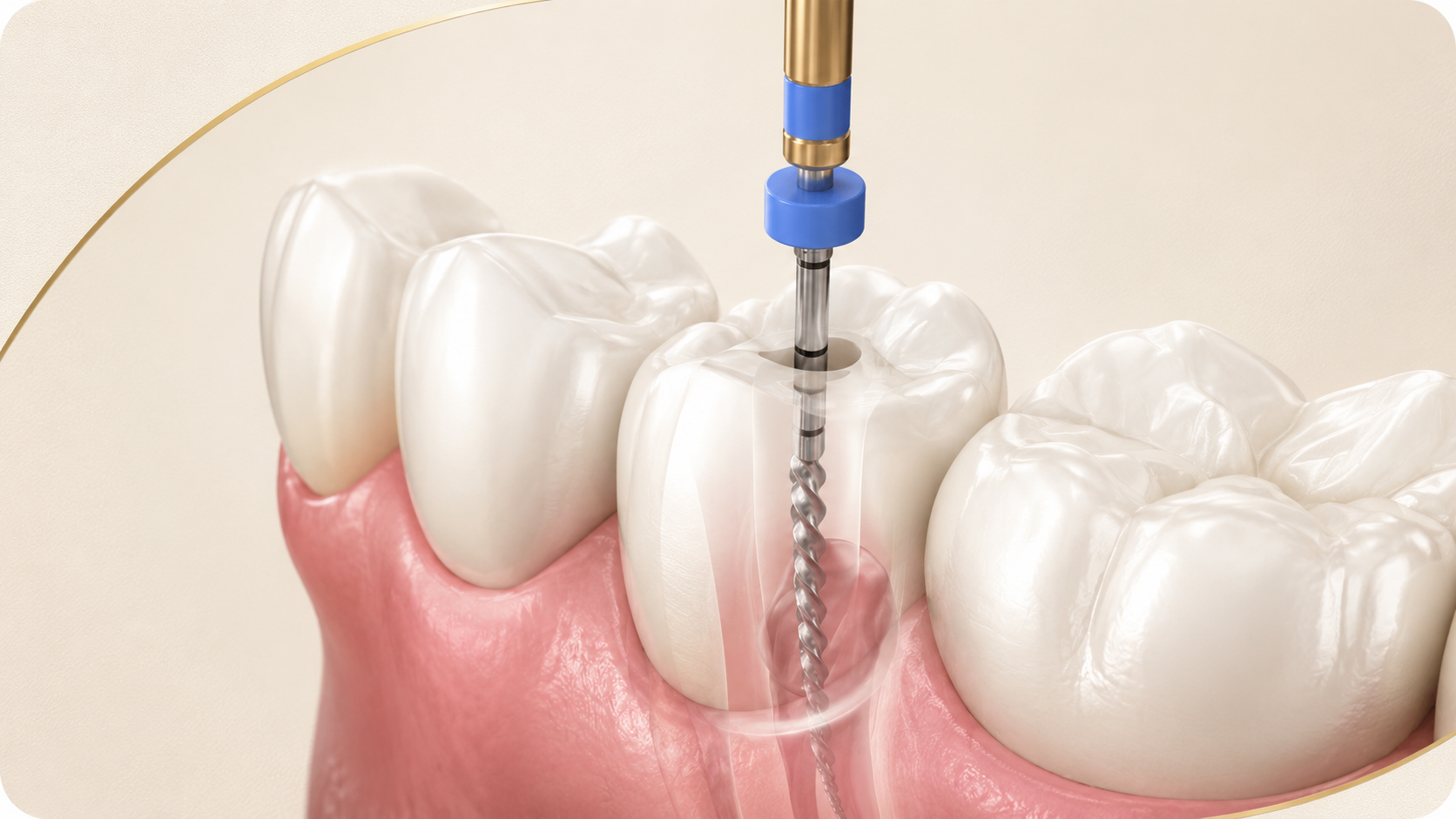 Illustration of root canal therapy being performed on a molar.