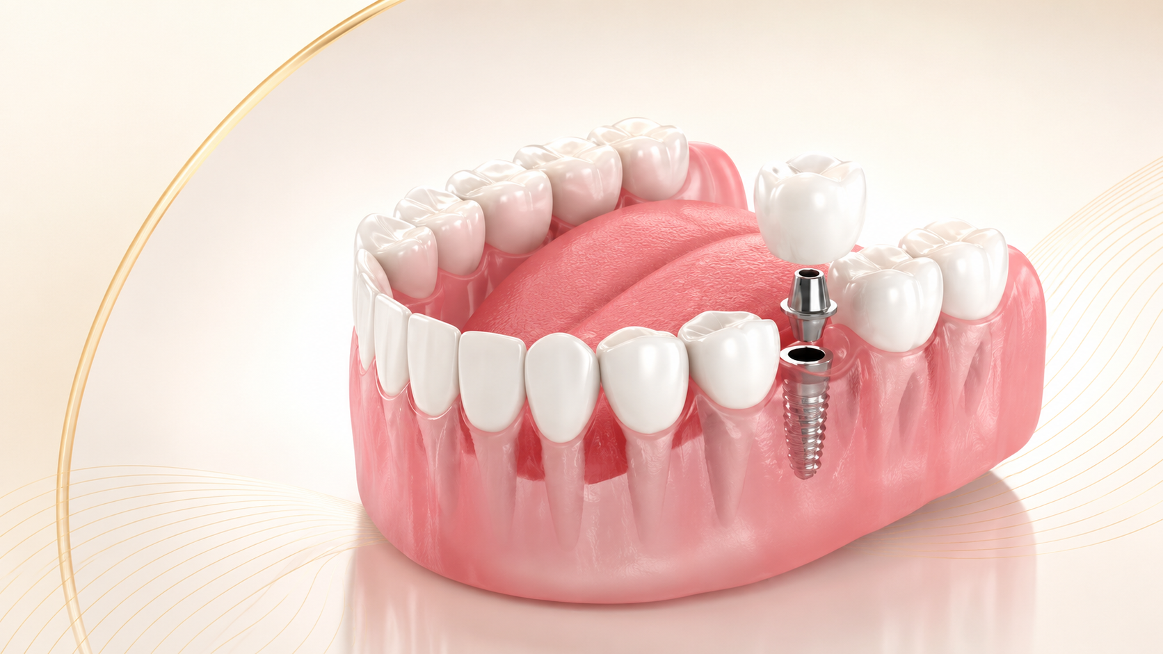Illustration showing the components of a dental implant restoration.